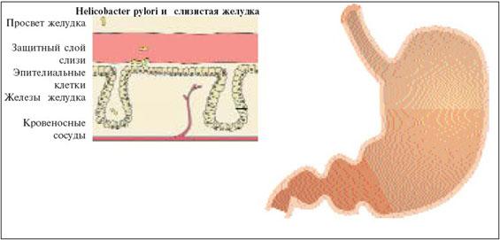 Helicobacter pylori (H. pylori) -  